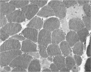 Acute Necrotising Myopathy