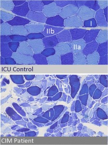 Minimal Change Critical Illness Myopathy (CIM)