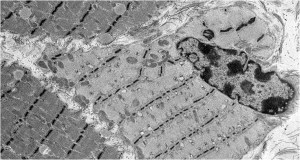 Patchy Myosin Filament loss in Thick Filament Myopathy