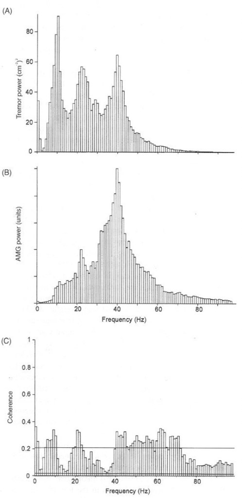 Same subject as in above figure under identical conditions. The microphone is not as sensitive at 10 Hz as 40 Hz, hence the larger 40 Hz peak compared with tremor and EMG.